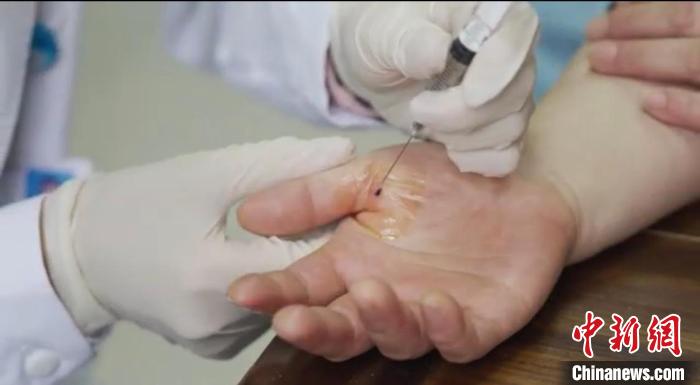 嘉善群眾體驗小針刀?！〖紊平y(tǒng)戰(zhàn) 供圖